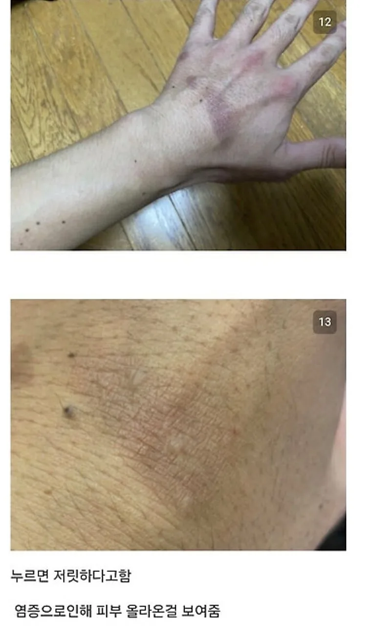 붉은사슴뿔버섯을 본인 몸에 실험한 일본인