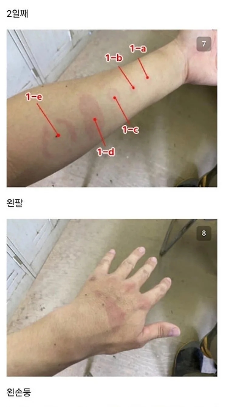붉은사슴뿔버섯을 본인 몸에 실험한 일본인