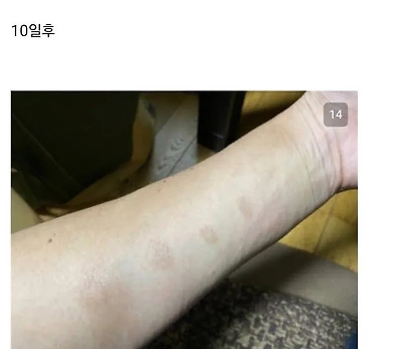 붉은사슴뿔버섯을 본인 몸에 실험한 일본인