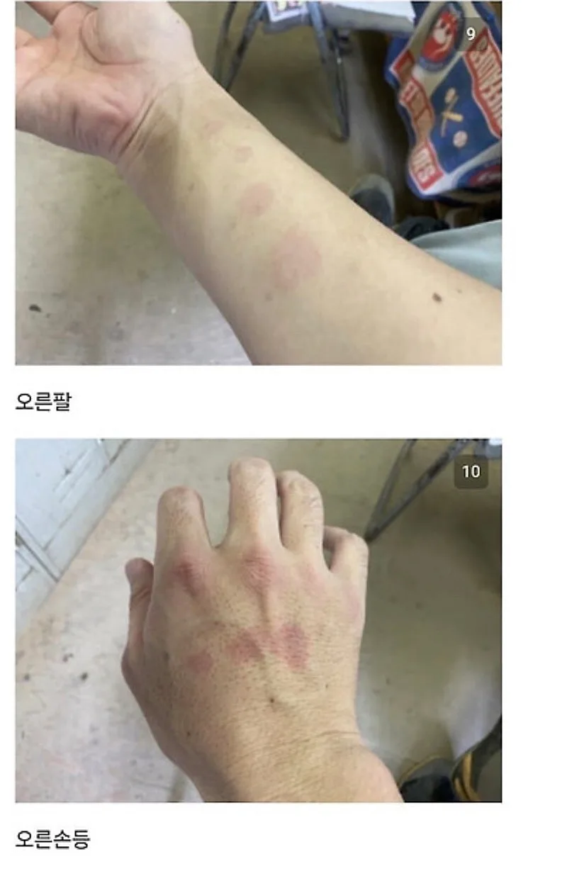 붉은사슴뿔버섯을 본인 몸에 실험한 일본인
