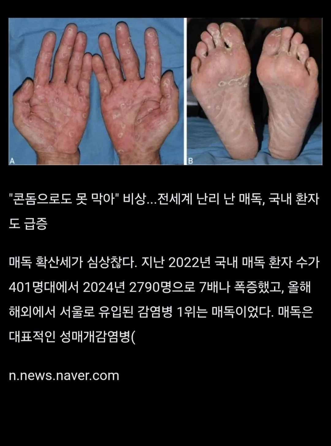 서울 덮친 '해외발 매독' 콘돔으로도 못막아 ..