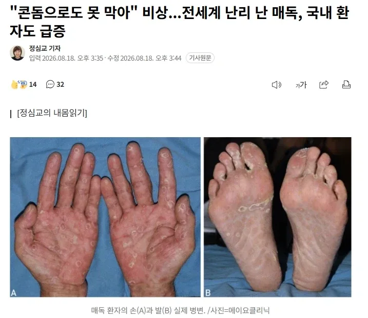 "콘돔으로도 못 막아" 비상...전세계 난리 난 매독, 국내 환자도 급증
