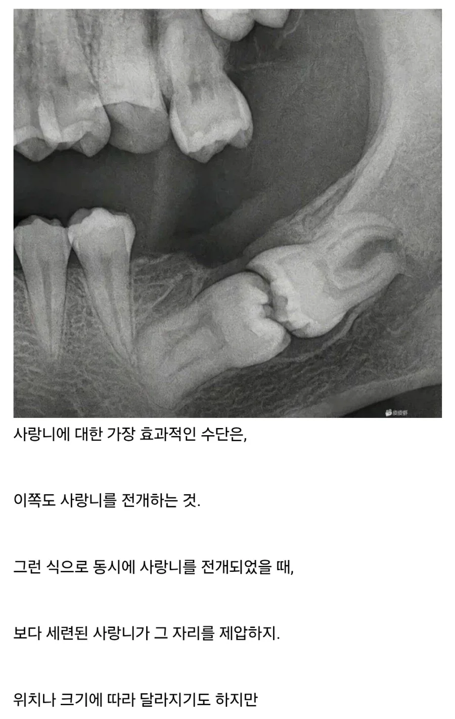 사랑니 영역전개.jpg