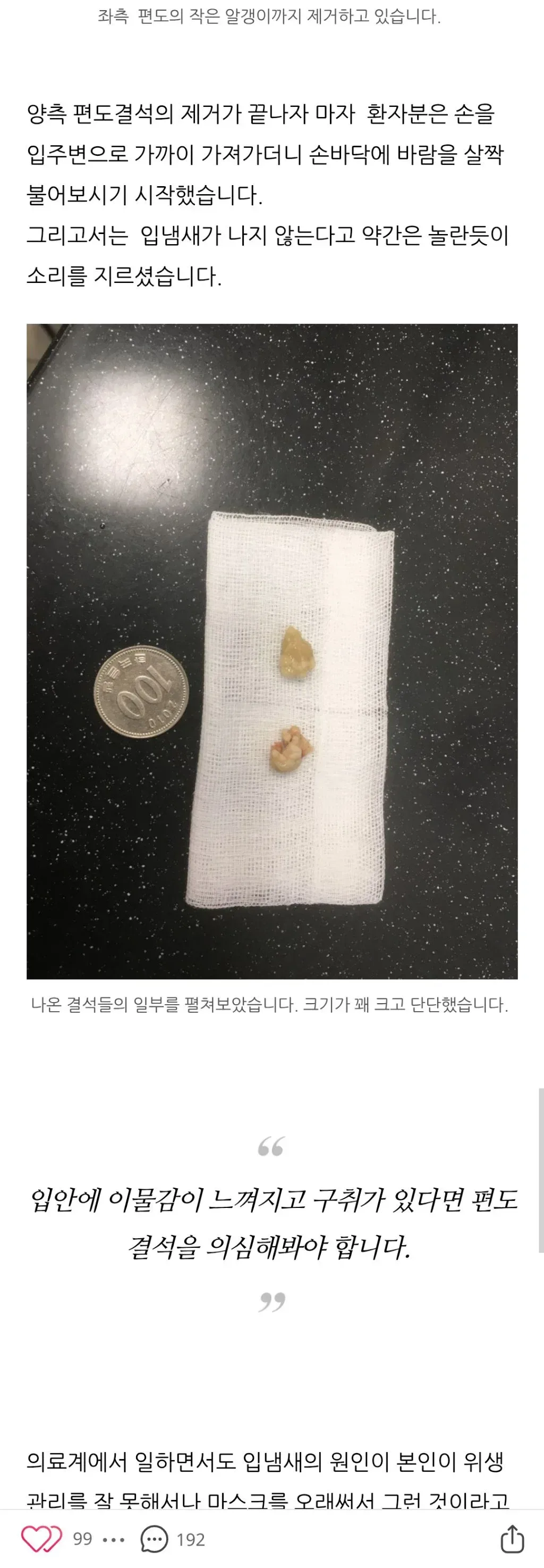 편도결석 ㄹㅈㄷ.jpg