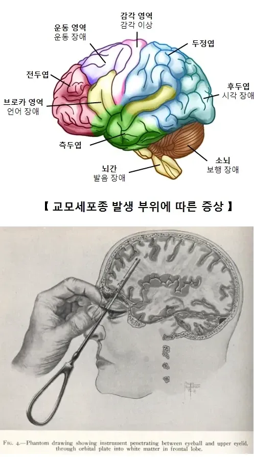 인류가 알고 있는 유일한 조현병 완치법_2.webp