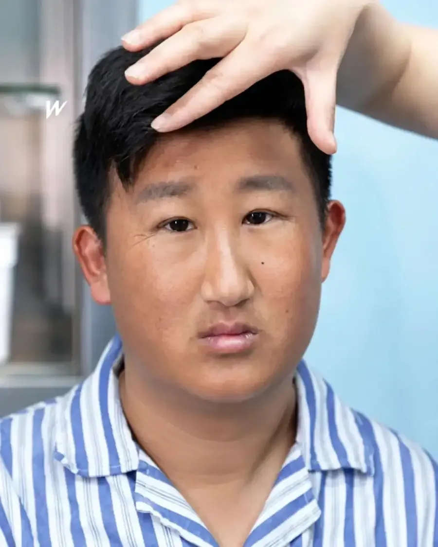 못 생긴 남자의 눈 수술 후기