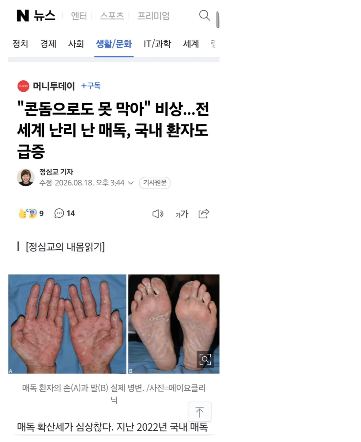 국내 매독 환자 폭증이래. 2년 사이에 7배 증가했고 콘돔으로도 못 막는대
