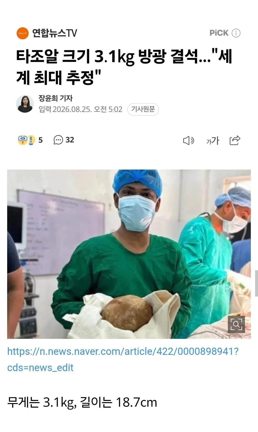 세계 최대 방광 결석