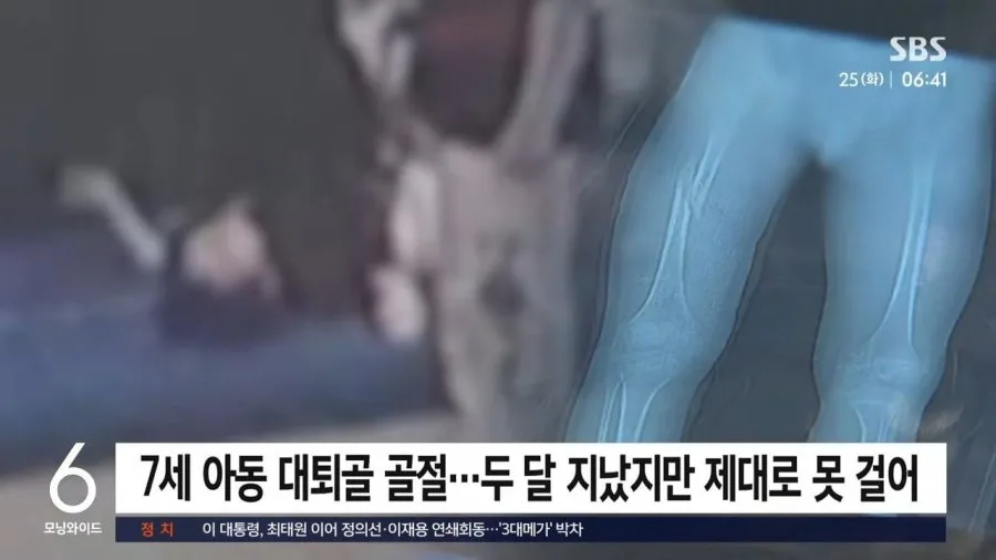 '다리 찢기'하다 7세 아이 대퇴골 골절시킨 태권도 관장.jpg