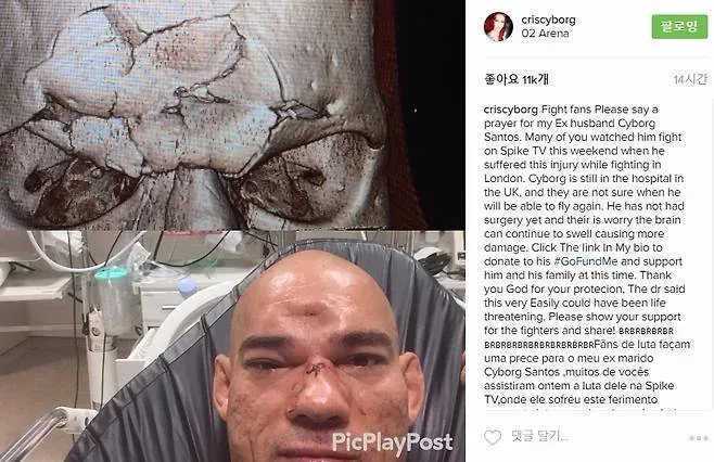 두개골이 부서졌다는 KO 장면