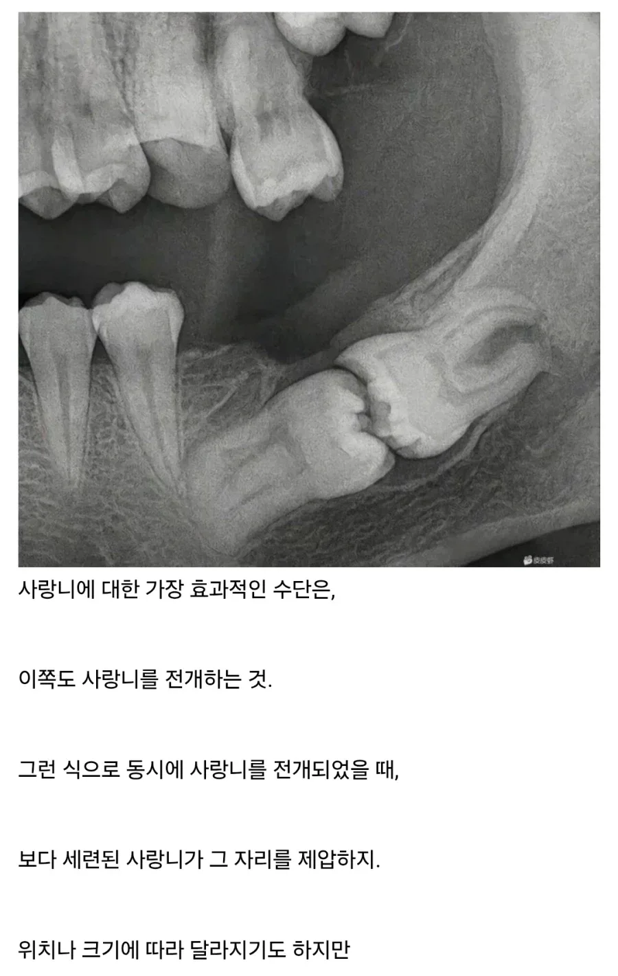 사랑니 영역전개.jpg