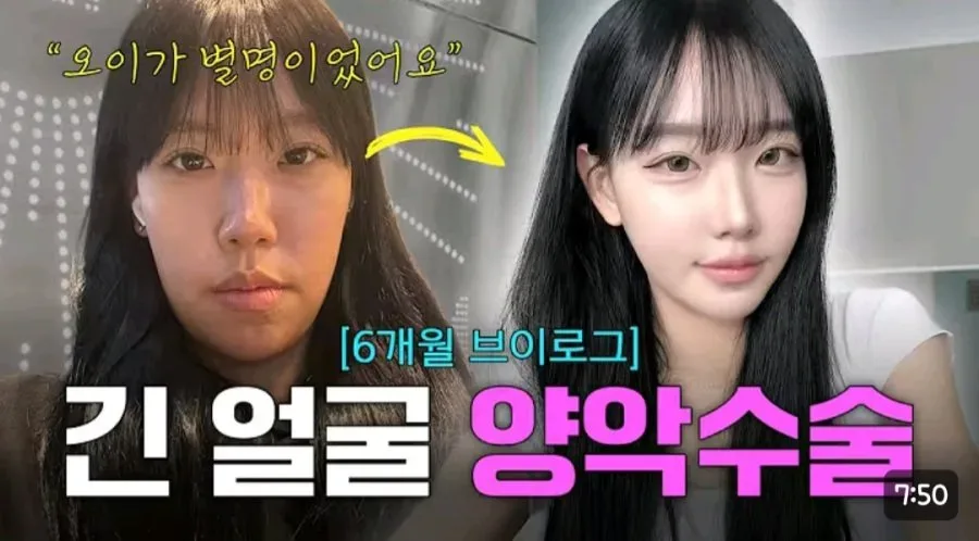 양악수술 전후 여자 외모 변화.jpg