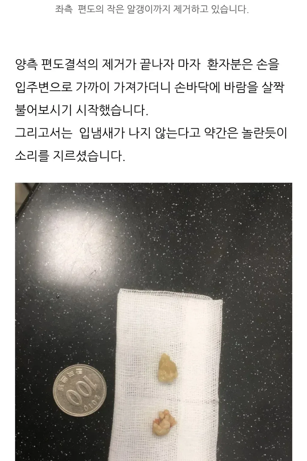 편도결석 ㄹㅈㄷ.jpg