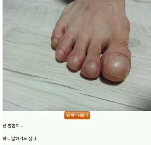 엄지발톱 인증 레전드