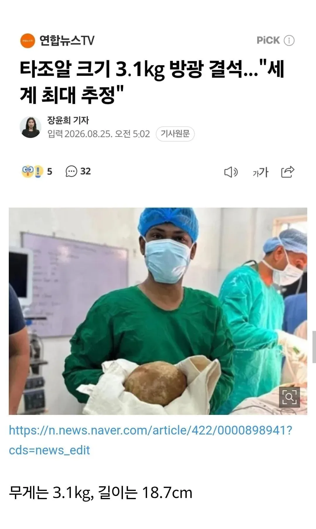 세계 최대 방광 결석